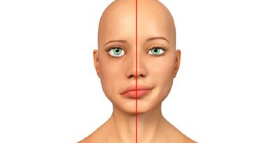 Facial nerve paralysis, Bell's palsy, bells palsy, bells paralysis
