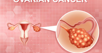 Ovarian Cancer