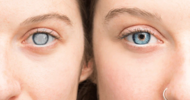 cataract
