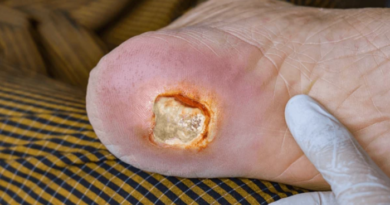 Diabetic Ulcer Foot