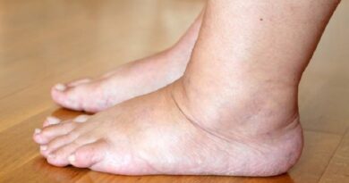 severe edema, Swollen legs of an elderly woman. Bare feet filled with water and became heavy.