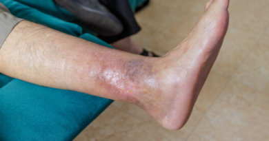 venous leg ulcer, venous ulcer, chronic leg ulcer