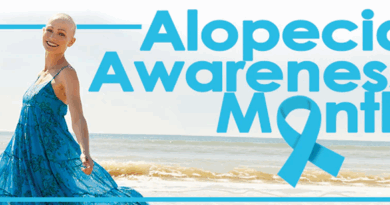 A girl showcasing Alopecia Awareness Month and its affect of baldness